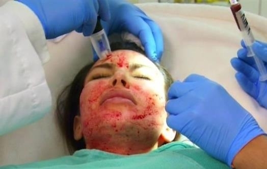 Vampire Facial