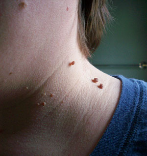 Skin Tags