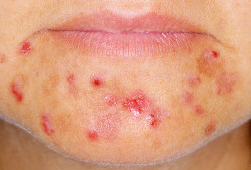 Seemingly Incurable Acne