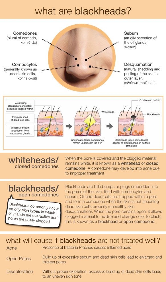 What Are Blackheads?