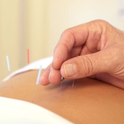Visit an Acupuncturist