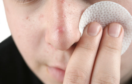 Are You Dealing with Acne?