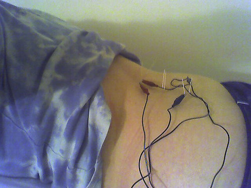 Acupuncture