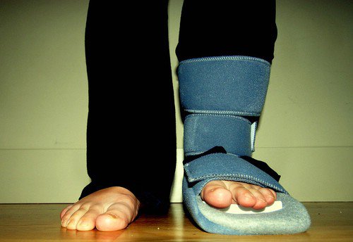 Plantar Fasciitis