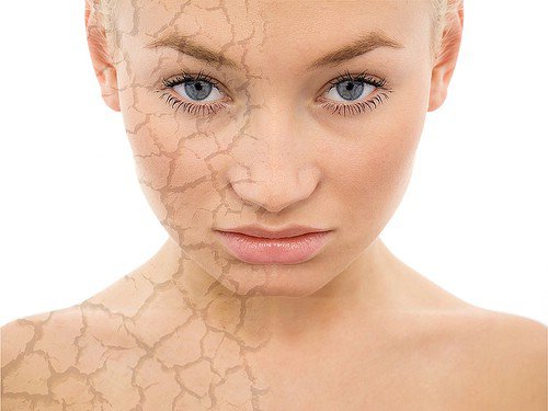 Chemical Peel