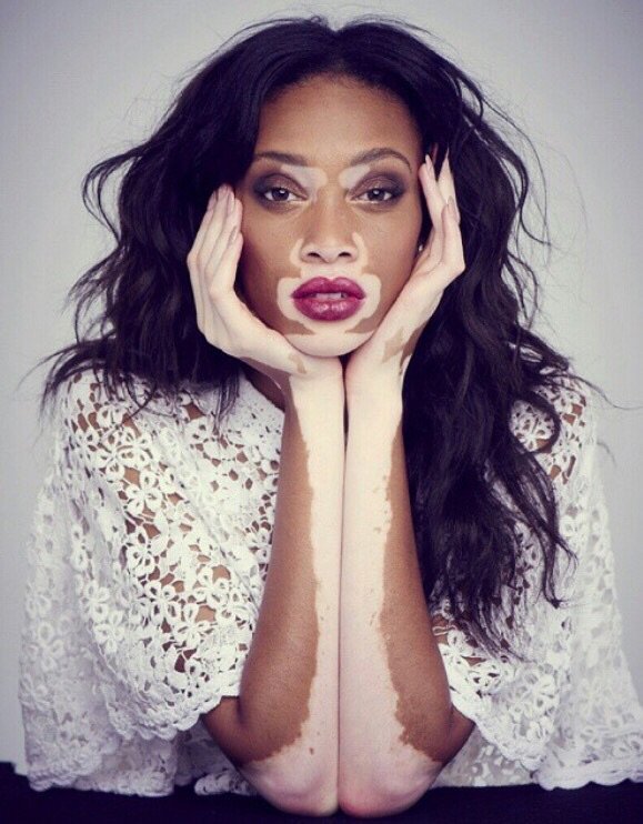 Winnie Harlow/Chantelle Brown Young